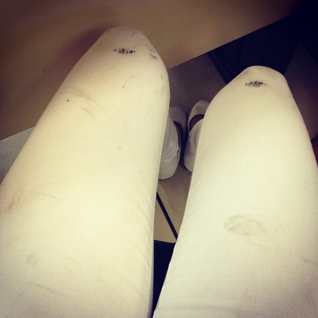Pernas de Adriana, ex-bbb, após ter sido sequestrada (Foto: Instagram / Reprodução)