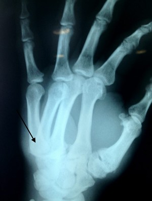 radiografia mão vitor belfort (Foto: Arquivo Pessoal)