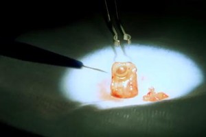 O cirurgião perfura o dente e insere uma lente dentro dele. Como é do próprio paciente, o corpo não rejeita o material  (Foto: Reprodução Youtube/Warappegov8ek)