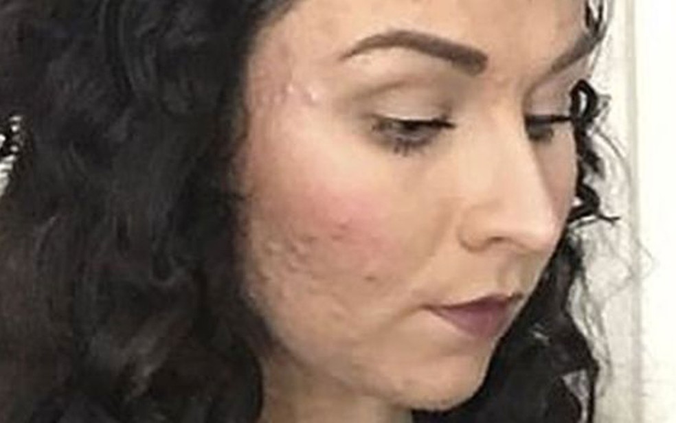 Judith reclama que nenhuma maquiagem era capaz de cobrir suas espinhas (Foto: Judith Donald)