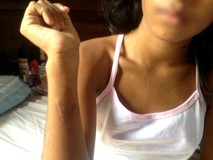 Menina mostra marcas das facadas levadas pelo corpo (Foto: Abinoan Santiago/G1)
