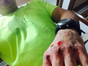 Mão esquerda do ciclista ficou bastante machucada, após o atropelamento (Foto: Arquivo pessoal)