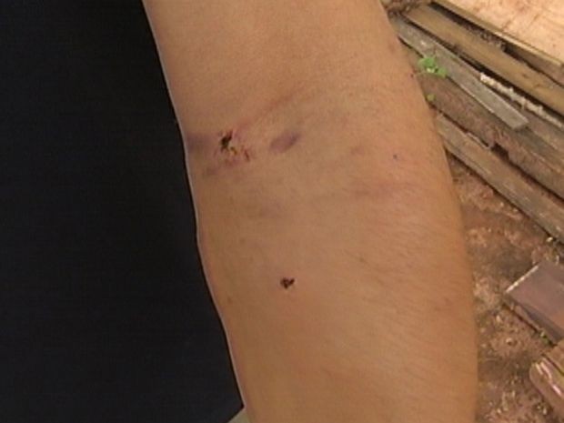 Homens acusados de agredir o animal mostraram as marcas das mordidas  (Foto: reprodução/TV Tem)