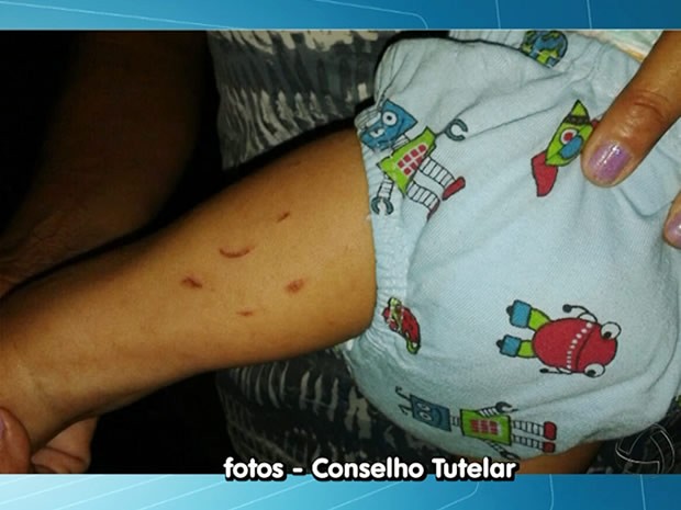 Criana deficiente teria sido vtima de maus-tratos em Mato Grosso. (Foto: Reproduo/TVCA)