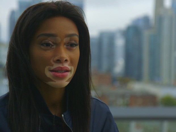 Winnie Harlow é uma top model canadense de 22 anos (Foto: BBC)