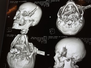 Em tomografria é possível ver a faca cravada no crânio do homem (Foto: Ellyo Teixeira/G1)