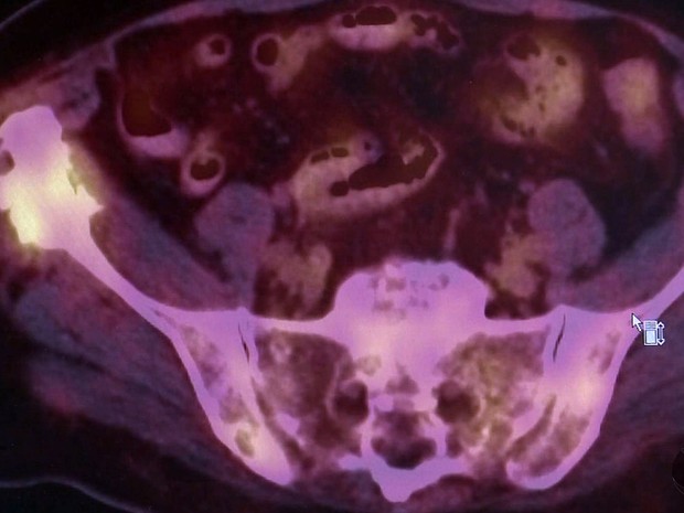 SUS oferece exame PET-CT para dignosticar câncer em Pouso Alegre (MG) (Foto: Reprodução EPTV) SUS oferece exame PET-CT para dignosticar câncer em Pouso Alegre (MG) (Foto: Reprodução EPTV)