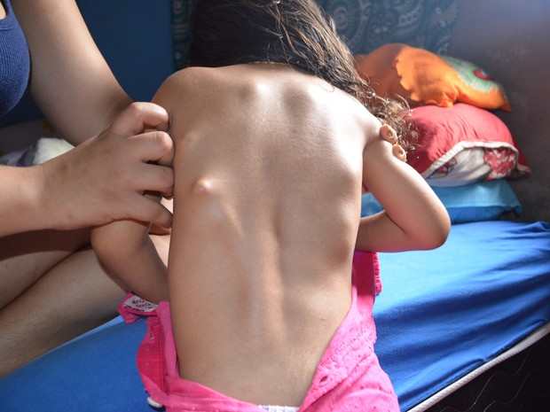 Doença provoca crescimento de esqueleto extra no corpo de Cristina (Foto: Aline Nascimento/G1)