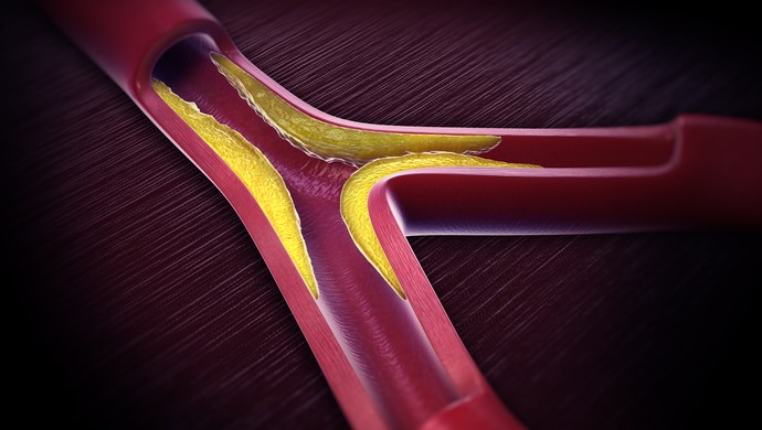 Aterosclerose artéria euatleta (Foto: Getty Images) Aterosclerose artéria euatleta (Foto: Getty Images)