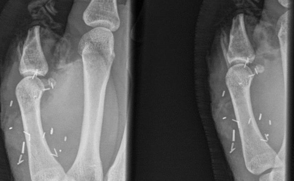 Cirurgiões tentaram reimplantar o polegar decepado duas vezes (Foto: South Eastern Sydney Local Health District)