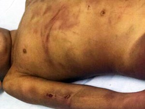 Criança estava com o braço quebrado e tinha marcas de mordida (Foto: Givanilse dos Santos/Arquivo Pessoal)