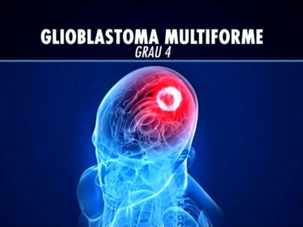 Camille foi diagnosticada com Glioblastoma Multiforme (Foto: Reprodução/RBS TV)