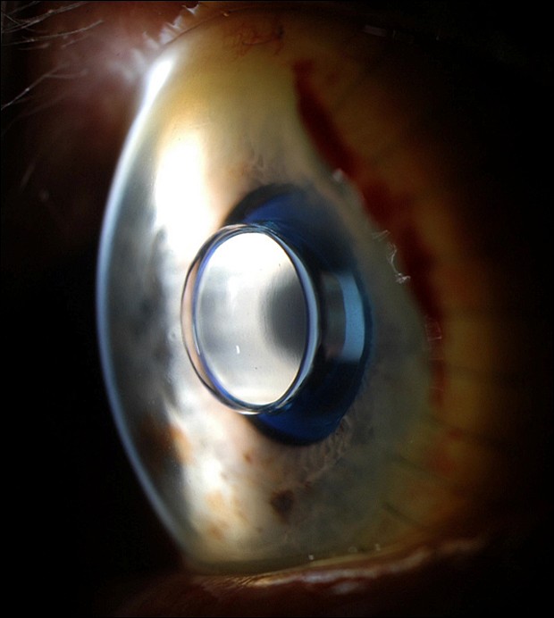 Implante olho (Foto: UC Davis)