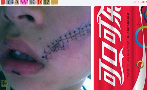 Garoto chinês mostra os pontos que levou após refrigerante explodir perto de seu rosto (Foto: Reprodução)