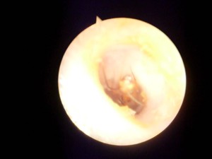 Formiga entra em ouvido de paciente (Foto: Divulgação/Secretaria Municipal de Saúde)