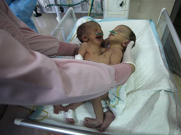 Gêmeas nasceram há três dias e são unidas pelo abdômen (Foto: Hazem Bader/AFP)