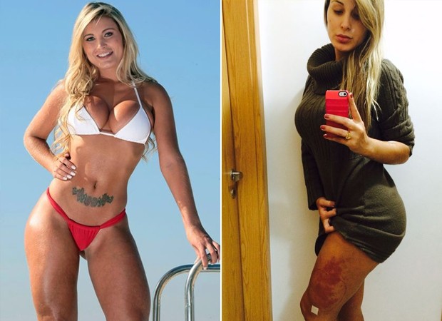 Antes e Depois - Próteses da perna de Andressa Urach (Foto: Divulgação)