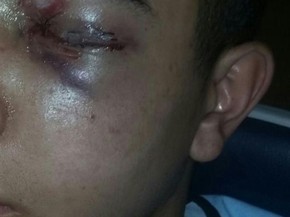 Adolescente de 15 anos fica cego do olho esquerdo após ser atingido por tiro de borracha (Foto: Arquivo Pessoal)