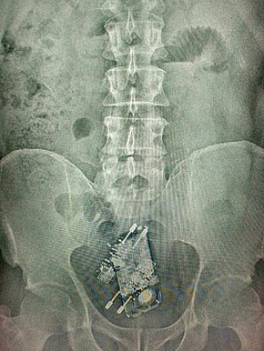 Raio X mostra celular e aparelhos de carregar bateria em sistema digestivo de preso em Brasília (Foto: Reprodução)