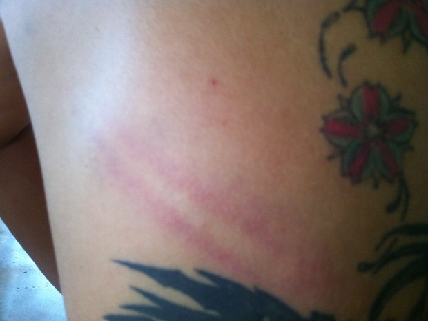 Empresária agredida pela PM, em Miranorte, ficou com marcas também nas costas (Foto: Arquivo Pessoal)