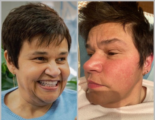 Claudia Rodrigues antes e depois da inflamação (Foto: Divulgação) Claudia Rodrigues antes e depois da inflamação (Foto: Divulgação)