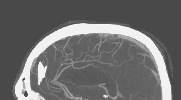 Bem Estar Zika Provoca Infecção Cerebral E Deixa Francês Em Coma Temporário 0009