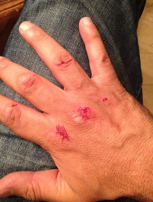 Mão de Renzo Gracie, ferida após briga com ladrões (Foto: Reprodução/Twitter)