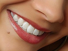 Lente De Contato Para Dente Corrige Imperfeicoes E Evita Desgaste Bem Estar G1