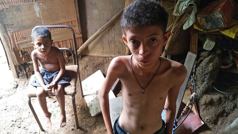 Menino venezuelano de 11 anos. Assim como muitas crianças no país, ele está desnutrido (Foto: Reprodução/BBC)