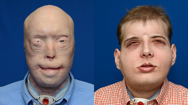  Paciente Patrick Hardison depois de acidente que deixou seu rosto deformado (esq.) e depois de receber um transplante de face (dir.)  (Foto: NYU Langone / AFP)