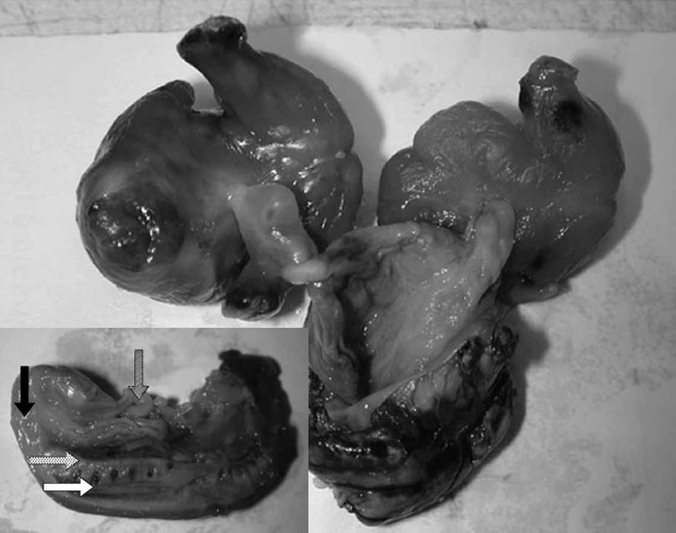   Imagens mostram os fetos retirados do bebê: detalhe mostra coluna vertebral em formação e até cordão umbilical (Foto: HKMJ/Divulgação)