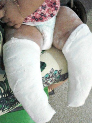 Bebê de 6 meses recomeçou tratamento para pés tortos nesta terça-feira (21) (Foto: Deuvanir Marçal de Souza/Arquivo Pessoal)