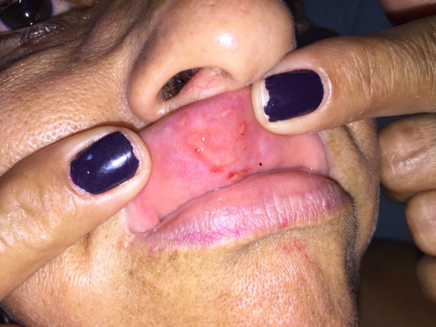 Francisca mostra ferimento deixado após levar soco na boca (Foto: Francisca Oliveira/Arquivo Pessoal)