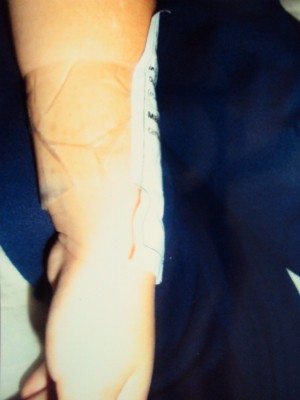 O braço da criança ficou com marcas da fita usada. (Foto: Arquivo Pessoal)