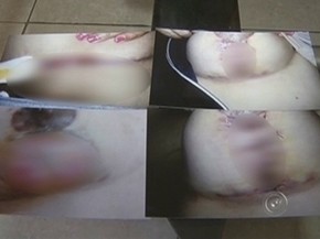Imagens mostram situação da mulher depois da cirurgia (Foto: Reprodução TV TEM)