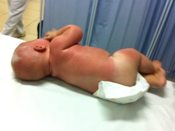 Criança teve queimaduras provocadas pelo sol por todo o corpo (Foto: Conselho Tutelar)