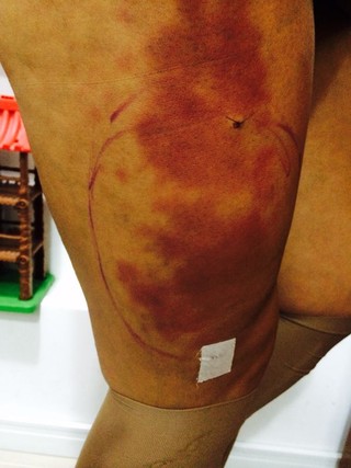 Cirurgia para retirada de próteses da perna de Andressa Urach (Foto: Divulgação)