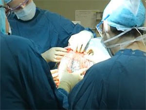 Prótese foi implantada na cabeça de mulher de 22 anos (Foto: Reprodução/YouTube/UMC Utrecht)