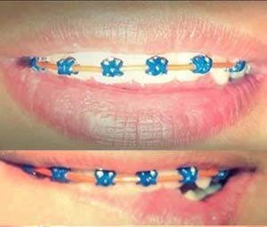Jovens usam acessrios dentrios de maneira irregular (Foto: Aparelhos Diferenciados/Divulgao/Facebook)