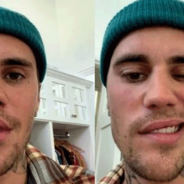 O cantor Justin Bieber foi diagnosticado com a síndrome de Ramsay Hunt, que paralisou metade de seu rosto.  O cantor Justin Bieber foi diagnosticado com a síndrome de Ramsay Hunt, que paralisou metade de seu rosto (Foto: Reprodução/Instagram)