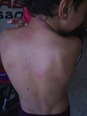 Várias crianças foram atingidas pelo ataque de abelhas em uma escola do município de Assu, no RN (Foto: Francisco Coelho/Focoelho.com)