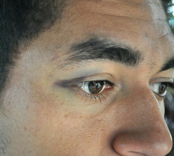 Januário mostra marca das agressões sofridas em assalto (Foto: Duaine Rodrigues)
