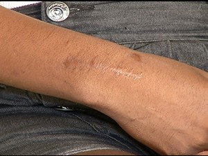Mulher tem uma cicatriz na mão (Foto: Reprodução/Inter TV Cabugi)