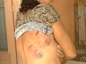 Vítima ficou com vários hematomas pelo corpo, em Goiânia, Goiás (Foto: Reprodução/ TV Anhanguera)