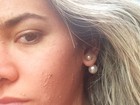 Ex-BBB Adriana Sant'anna posta foto após fazer peeling no rosto