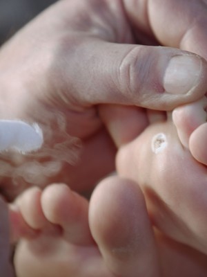 Sabe o que é olho de peixe ou verruga plantar Conheça sinais e tratamentos