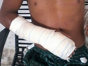 Homem mostra o braço que teria sido quebrado durante tortura (Foto: Arquivo Pessoal)