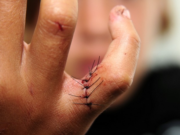 Menina disse que teve o dedo cortado pela família que a acusava de furto em Várzea Paulista (Foto: Rui Carlos/Jornal de Jundiai Regional)