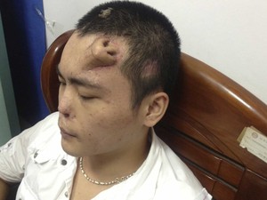 Paciente identificado com Xiaolian, 22 anos, é visto com 