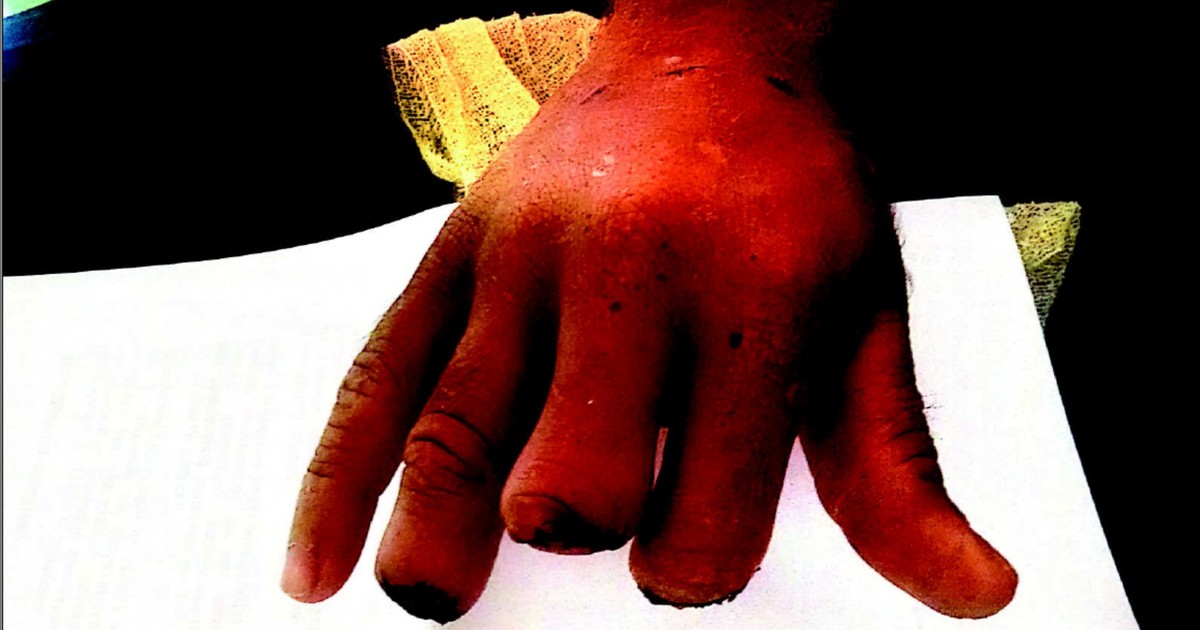 G1 Trabalhador que perdeu 3 dedos